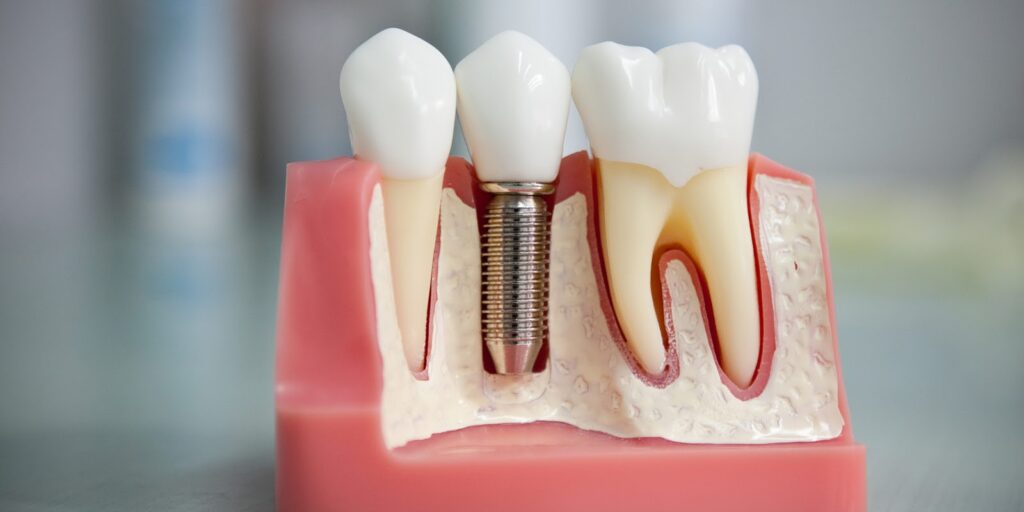 Неожиданные и приятные преимущества зубных имплантов